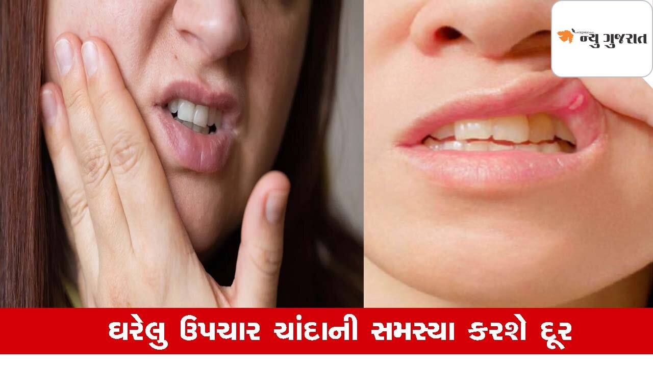 Health Tips: ગરમીમાં મોંઢામાં ચાંદાની સમસ્યાથી છો પરેશાન, આ ઉપચાર આપશે રાહત