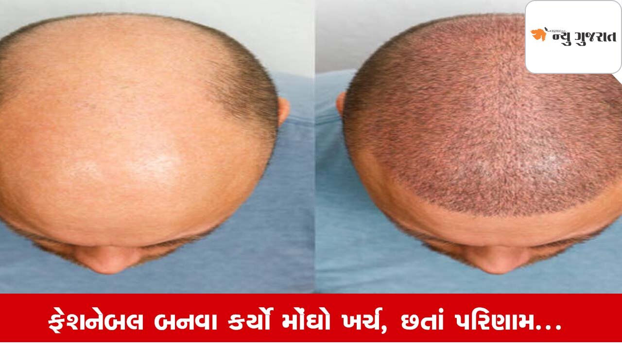 Hair Transplant: આકર્ષક દેખાવાના મોહમાં 'હેર ટ્રાન્સપ્લાન્ટ' બની શકે જીવલેણ, Safety જરૂરી