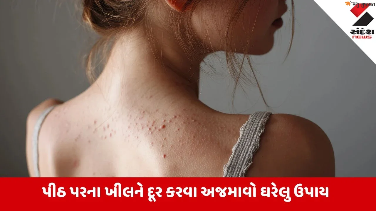 Beauty Tips: પીઠ પરના ખીલ થશે દૂર, અજમાવો આ સહેલા ઘરગથ્થુ ઉપચાર
